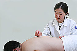 Acupuncture treatment